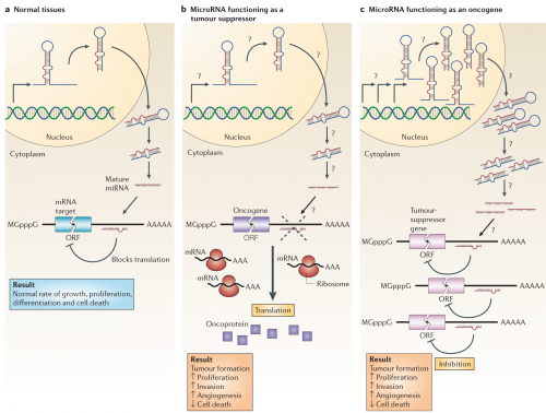 MicroRNAs can function as tumour suppressors and oncogenes. a | In normal tissues, proper microRNA (miRNA) transcription, processing and binding to complementary sequences on the target mRNA results in the repression of target-gene expression through a block in protein translation or altered mRNA stability (not shown). The overall result is normal rates of cellular growth, proliferation, differentiation and cell death. b | The reduction or deletion of a miRNA that functions as a tumour suppressor leads to tumour formation. A reduction in or elimination of mature miRNA levels can occur because of defects at any stage of miRNA biogenesis (indicated by question marks) and ultimately leads to the inappropriate expression of the miRNA-target oncoprotein (purple squares). The overall outcome might involve increased proliferation, invasiveness or angiogenesis, decreased levels of apoptosis, or undifferentiated or de-differentiated tissue, ultimately leading to tumour formation. c | The amplification or overexpression of a miRNA that has an oncogenic role would also result in tumour formation. In this situation, increased amounts of a miRNA, which might be produced at inappropriate times or in the wrong tissues, would eliminate the expression of a miRNA-target tumour-suppressor gene (pink) and lead to cancer progression. Increased levels of mature miRNA might occur because of amplification of the miRNA gene, a constitutively active promoter, increased efficiency in miRNA processing or increased stability of the miRNA (indicated by question marks). ORF, open reading frame.